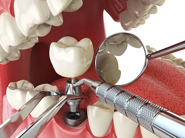 Best Emergency Treatment for Dental Infections or Abscesses in San Marcos, CA